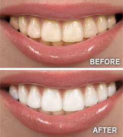 Teeth Whitening in Lincoln Park, Lakeview, & Chicago - Before & After
