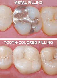 Tooth Colored Fillings Lincoln Park, Lakeview, Chicago