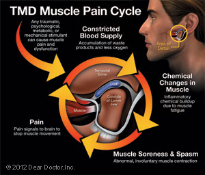 TMD Muscle Pain Cycle Chicago