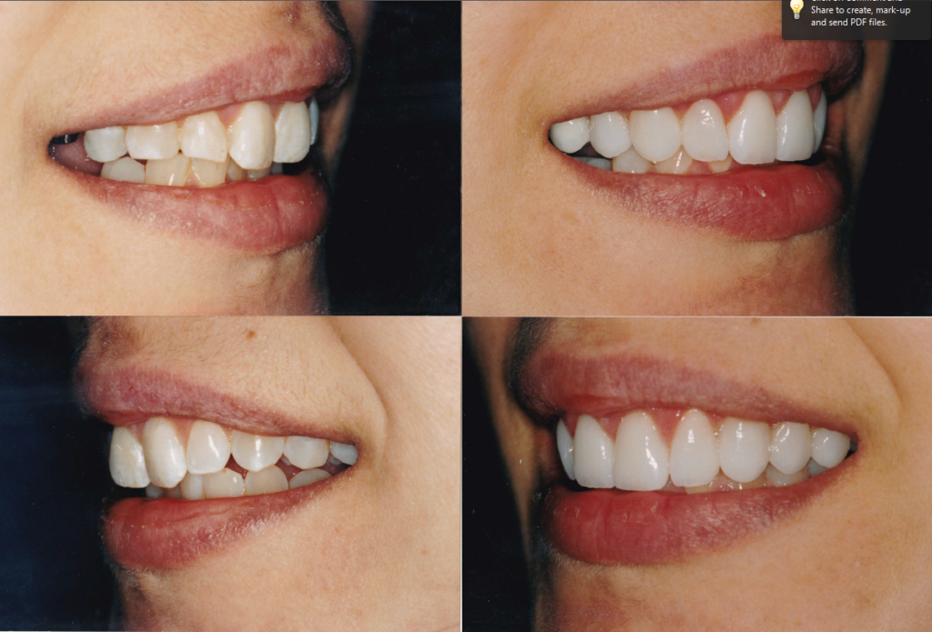 Veneers Chicago, Lakeview, Lincoln Park Get Custom Porcelain Veneers