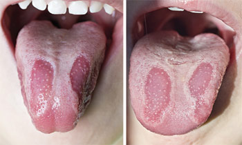 Geographic Tongue - Causes & Treatments Lincoln Park, Lakeview, Chicago