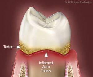 Non-Surgical Periodontal Treatment Lincoln Park, Lakeview, Chicago