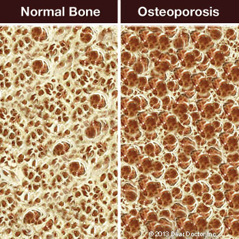 Osteoporosis & Oral Health Lincoln Park, Lakeview, Chicago