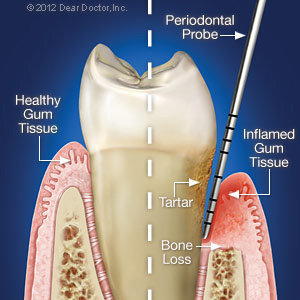 perio-disease-300