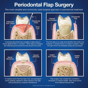 Flap Surgery Procedure Lincoln Park, Lakeview, Chicago