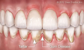 Periodontal Flap Surgery Lincoln Park, Lakeview, Chicago