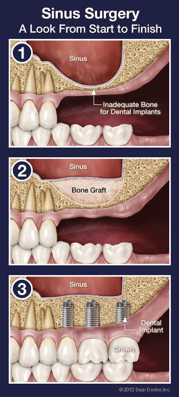 Sinus Surgery Procedure Lincoln Park, Lakeview, Chicago