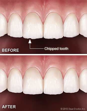 Tooth Contouring & Reshaping Lincoln Park, Lakeview & Chicago
