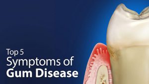 top5-symptoms-of-gum-disease2