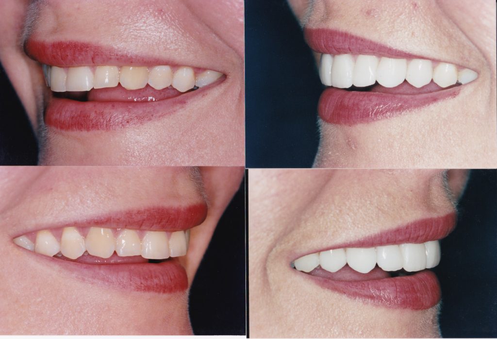 Veneers Chicago, Lakeview, Lincoln Park Get Custom Porcelain Veneers