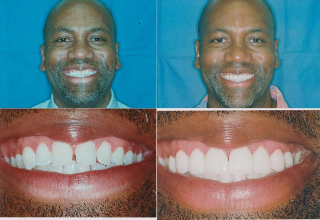 Veneers Chicago, Lakeview, Lincoln Park Get Custom Porcelain Veneers