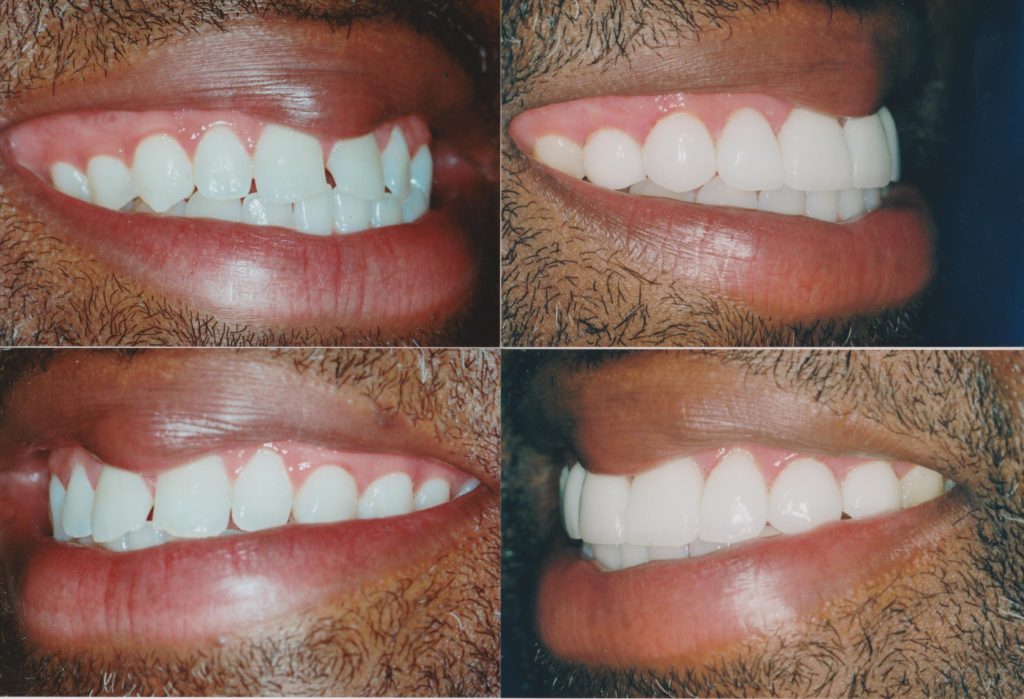 Veneers Chicago, Lakeview, Lincoln Park Get Custom Porcelain Veneers