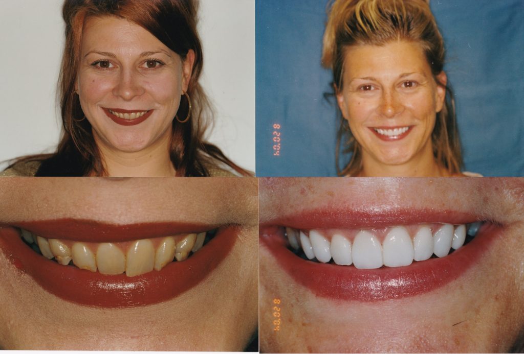 Veneers Chicago, Lakeview, Lincoln Park Get Custom Porcelain Veneers