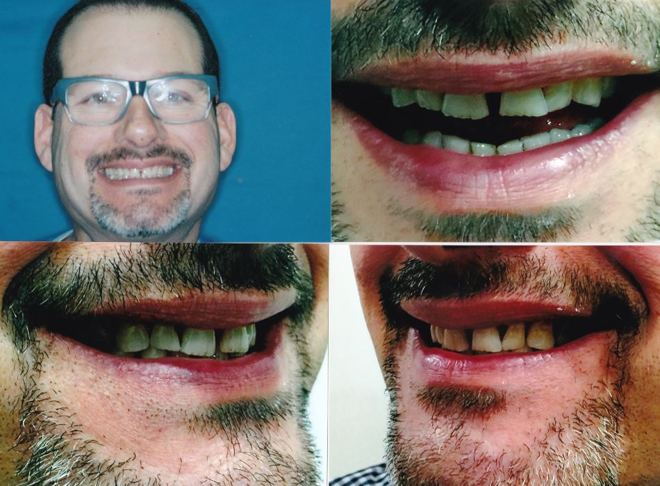 Veneers Chicago, Lakeview, Lincoln Park Get Custom Porcelain Veneers