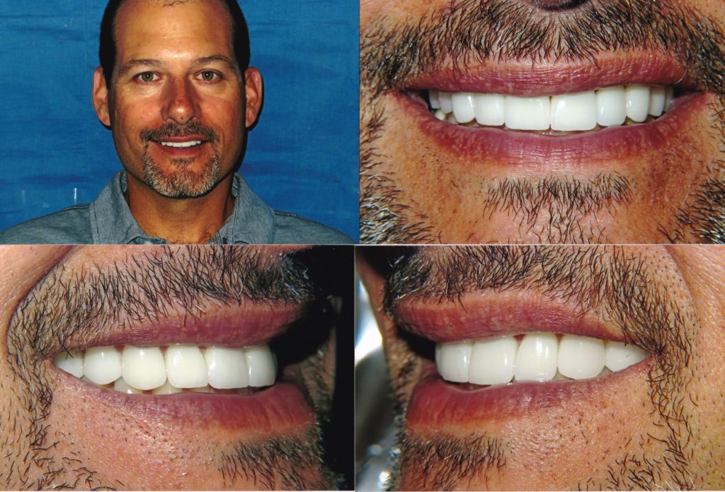 Veneers Chicago, Lakeview, Lincoln Park Get Custom Porcelain Veneers
