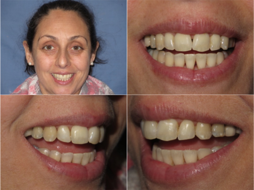 Invisalign Chicago, Lincoln Park, Lakeview Get Invisible Clear Braces